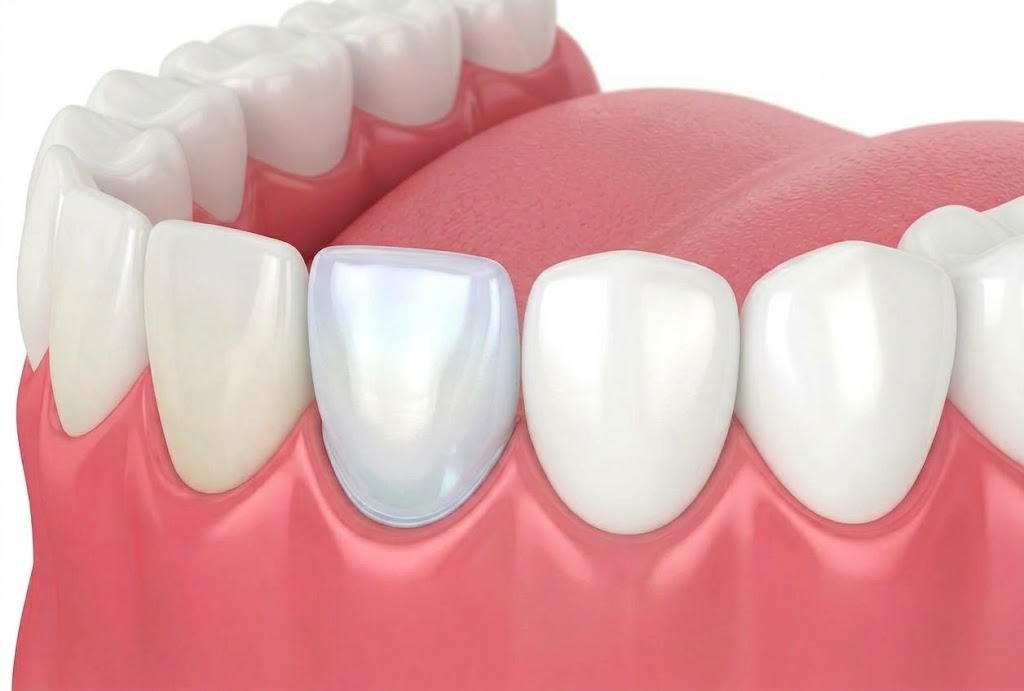 Porcelain E-max Veneers