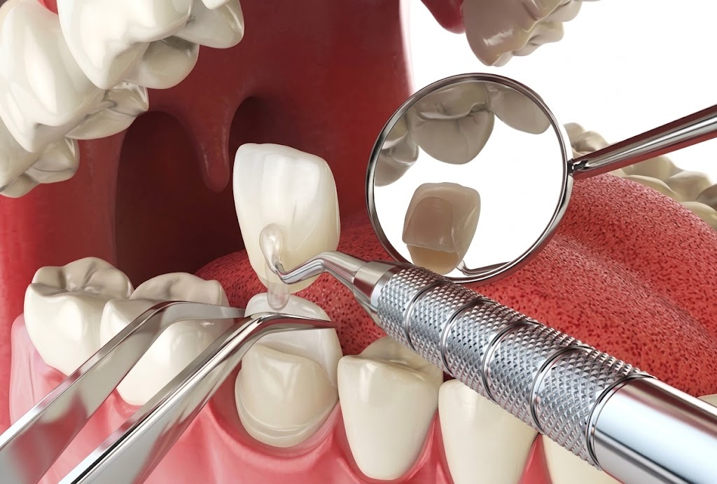 Composite Veneers / Bonding