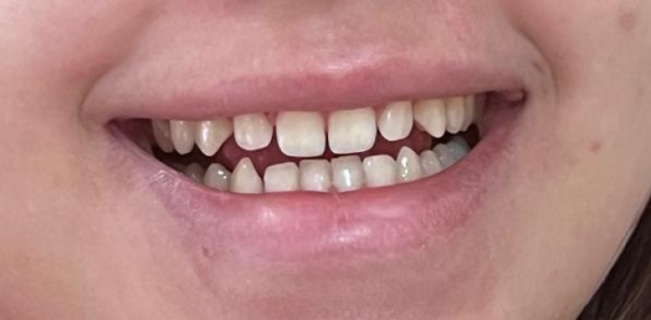 Before Single Tooth Implant
