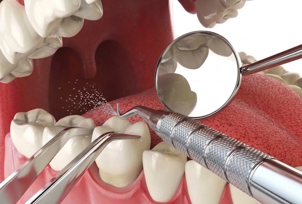 Minimal Tooth Shaving (If Needed)