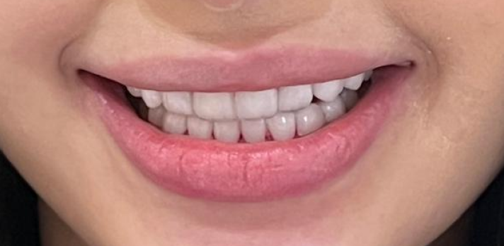 After Single Tooth Implant
